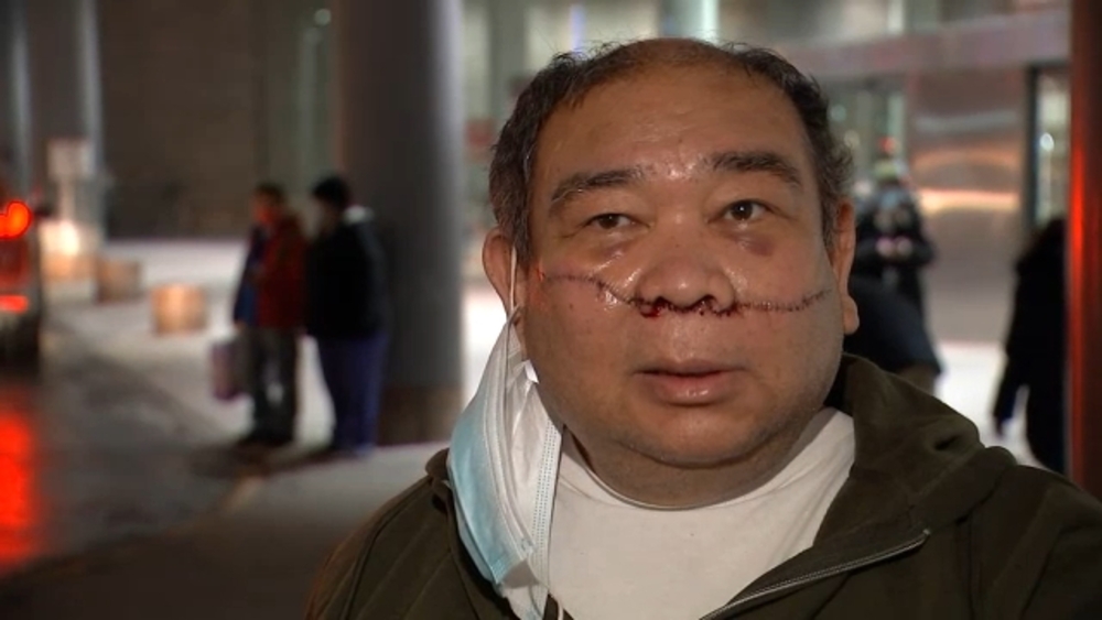 Exclusive: Man slashed across face in subway dispute speaks out
