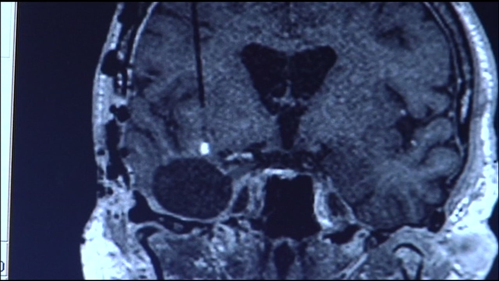 Post COVID-19 brain-related symptoms may be common, UCSF study indicates
