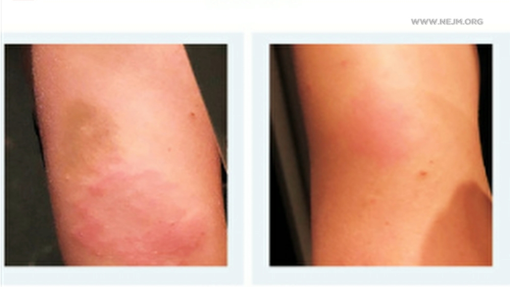 Delayed skin reaction appears for some after Moderna shot