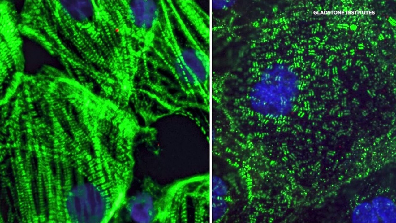 Researchers probe how COVID-19 attacks the heart