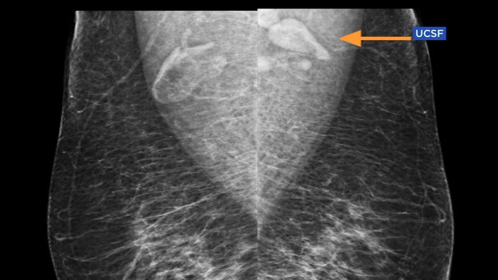 Women reporting swollen lymph nodes after COVID-19 vaccine