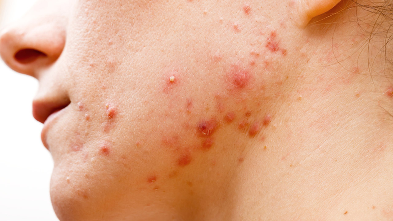 Treating acne
