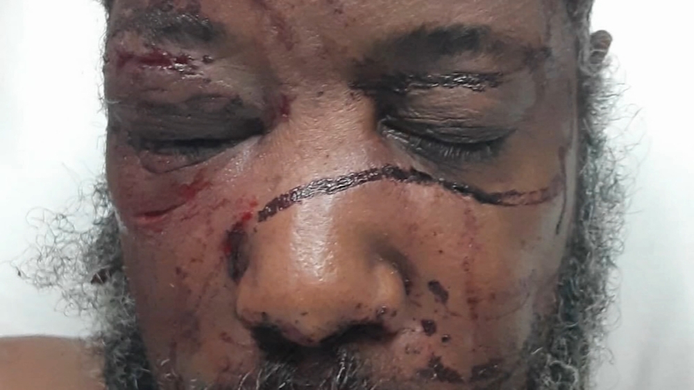 Man brutally beaten by neighbor says attack was fueled by racism