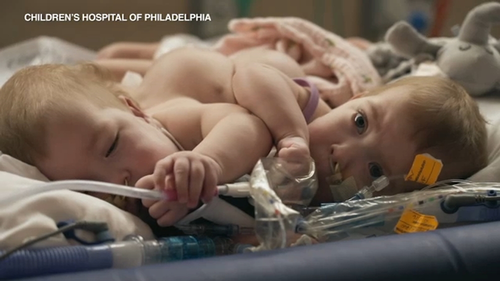 Conjoined Altobelli twins separated; family returns to Chicago after procedure in Philadelphia