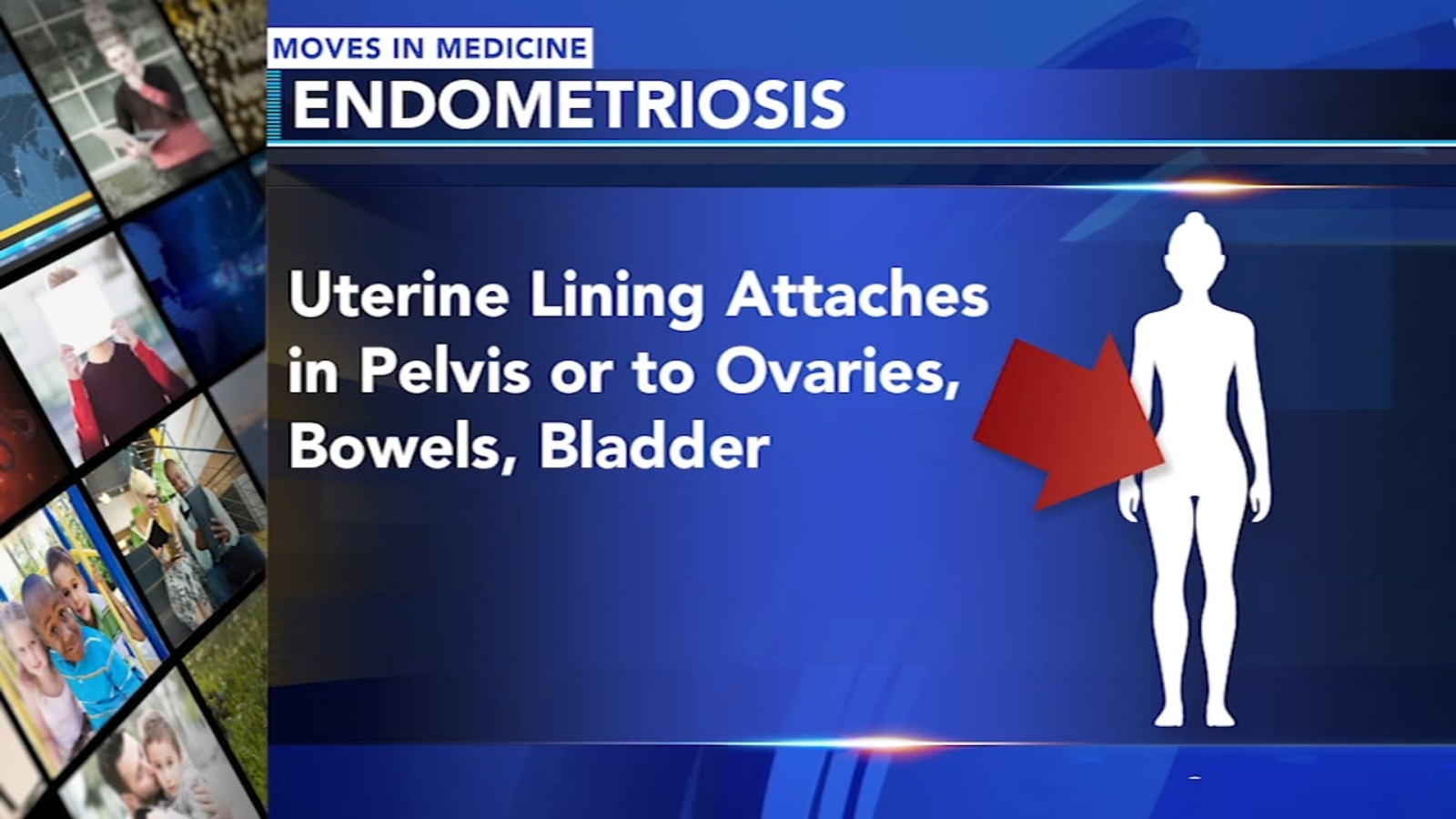 bpc 157 endometriosis GLP-1 in Endometriosis: What We Know So Far