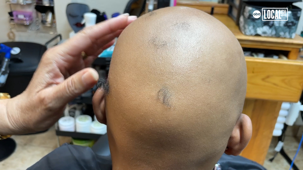 Hair designer restores people's hair to help them restore their Lives