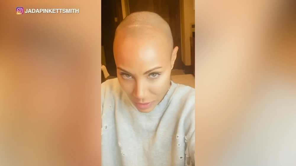 What is alopecia? Doctor explains hair loss condition
