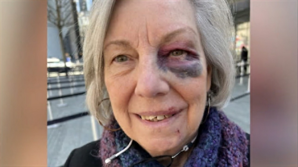 Tourist suffers black eye, chipped tooth after intentionally tripped
