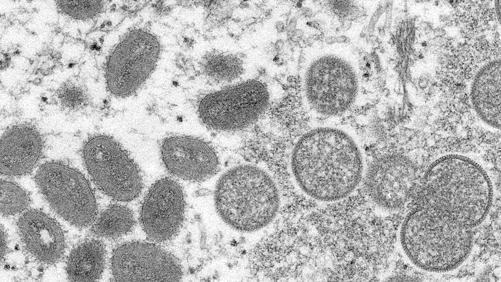 What is Monkeypox & should you worry? Q&A with Dr. David Wohl