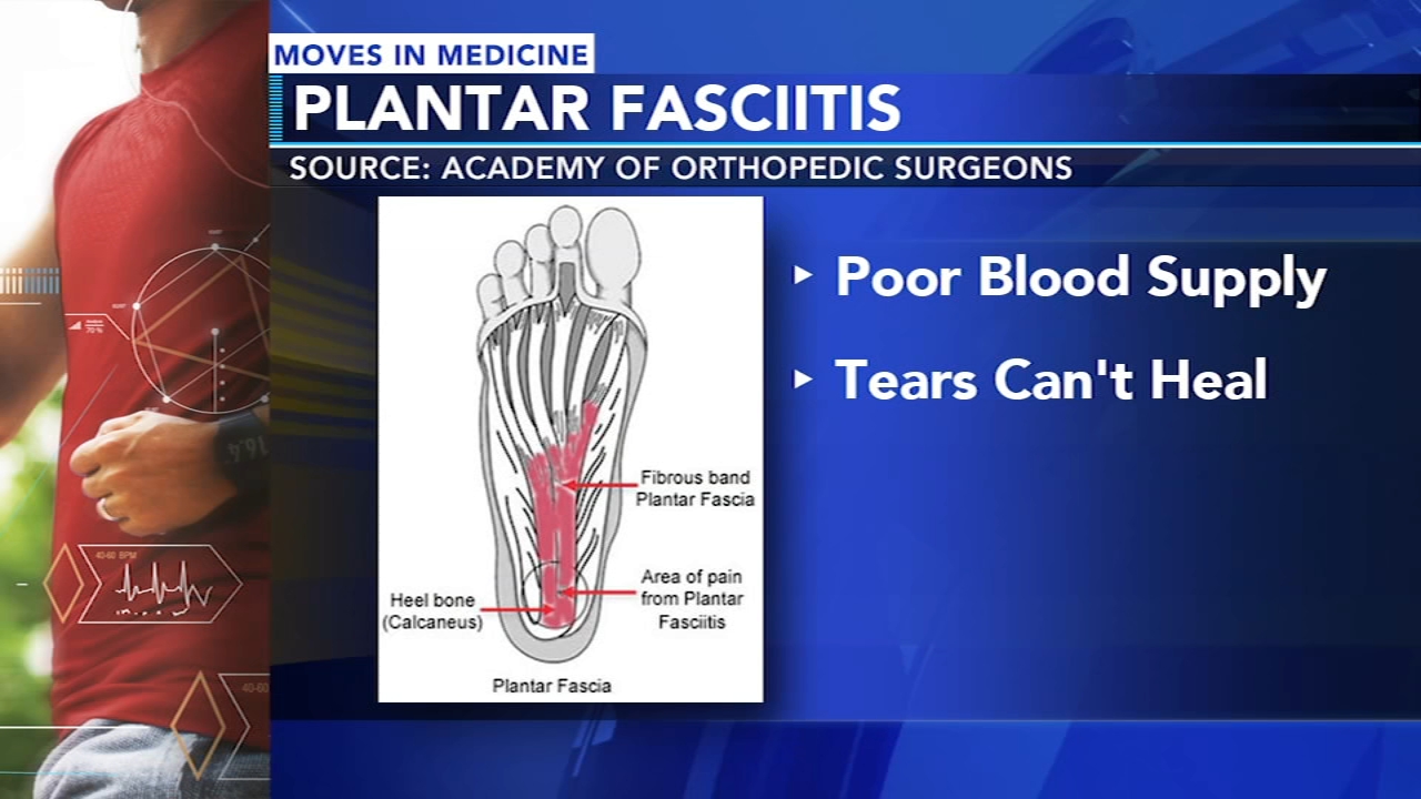 Your foot pain might be plantar fasciitis. Here's how to treat it