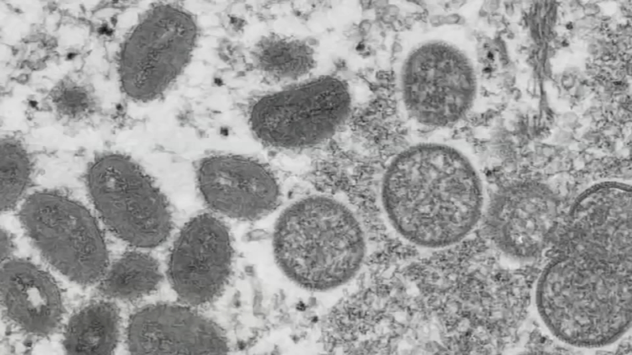 CDC testing confirms monkeypox in Philly resident