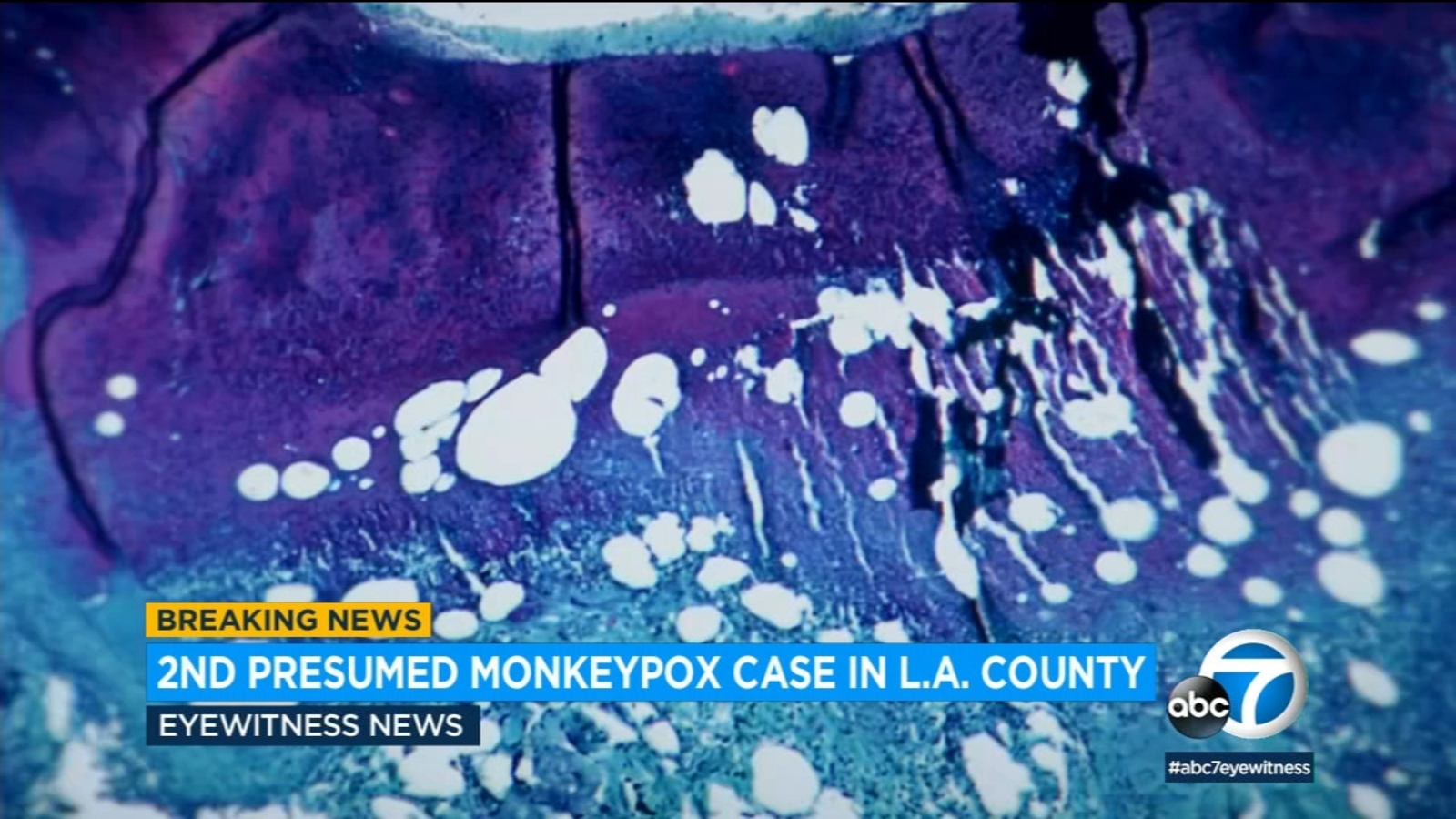 Los Angeles County confirms 2nd presumptive case of monkeypox; resident ...