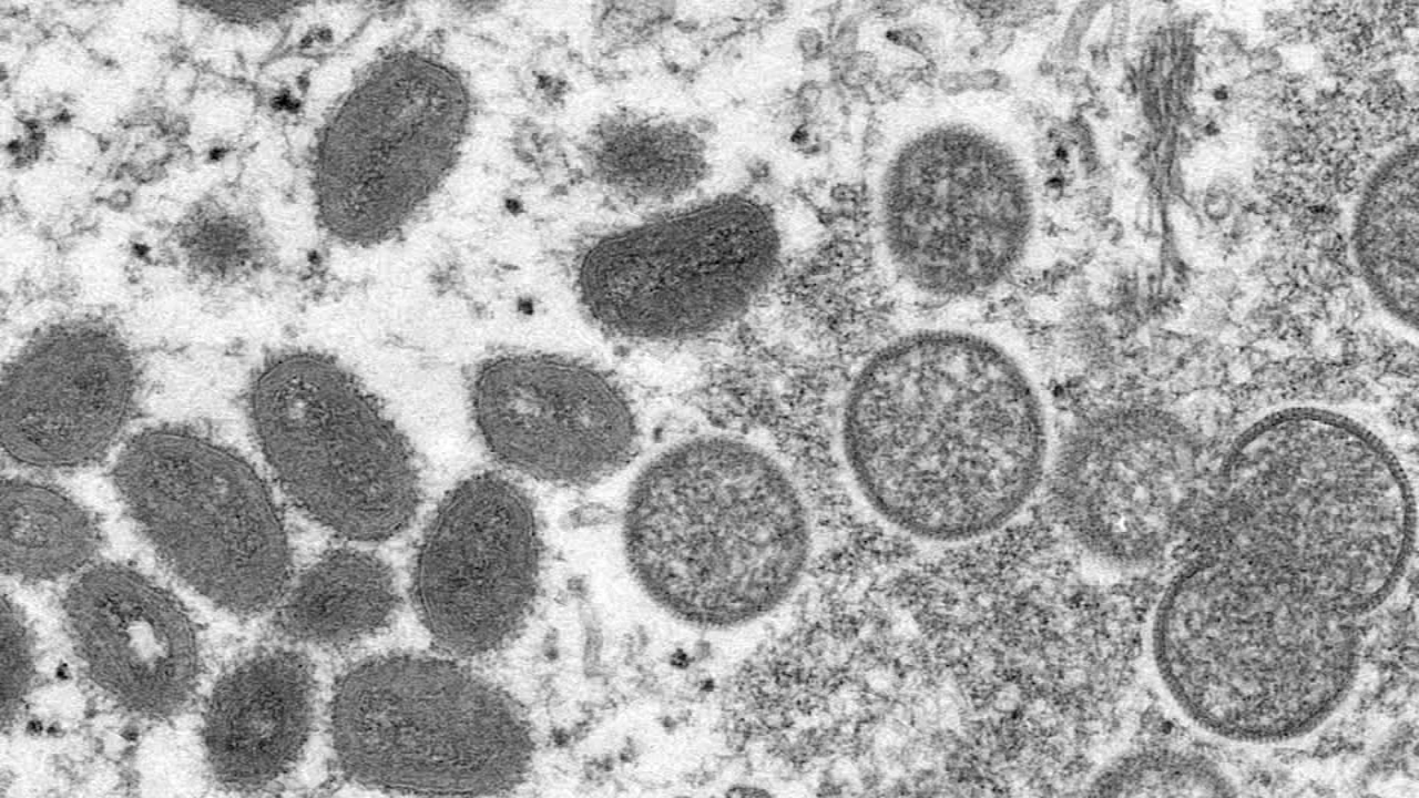 First monkeypox case confirmed in North Carolina