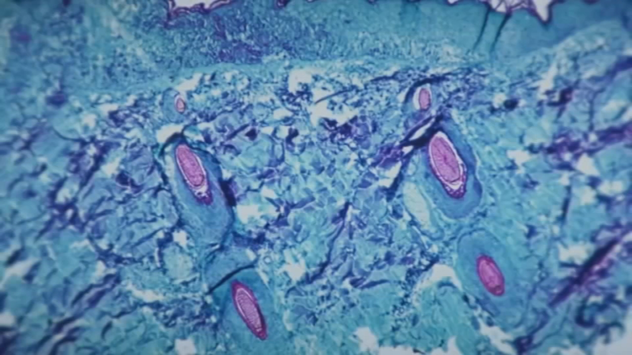 First case of monkeypox confirmed in Durham County