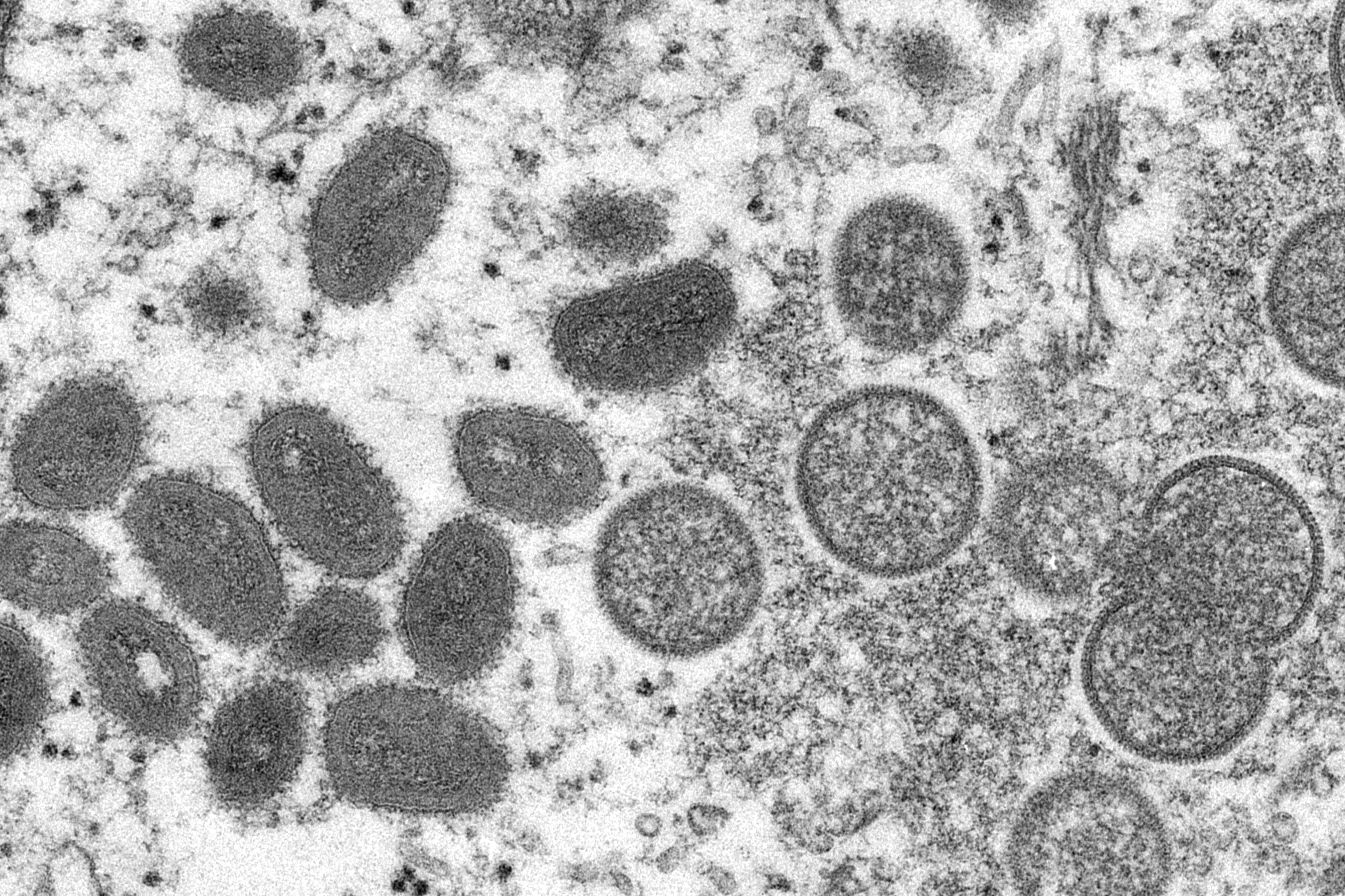 Galveston Co. health officials confirm 1st probable case of monkeypox