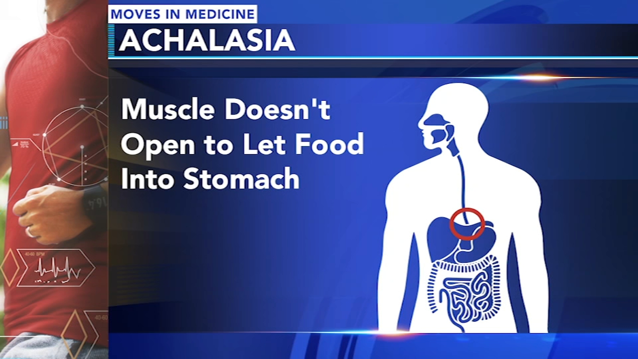 Treating achalasia, a condition that impacts eating, swallowing
