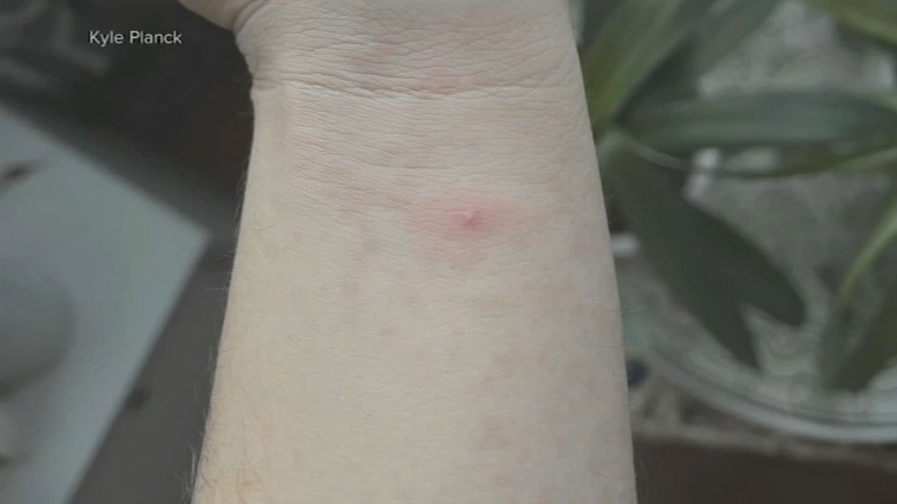 Monkeypox outbreak prompts public health emergency
