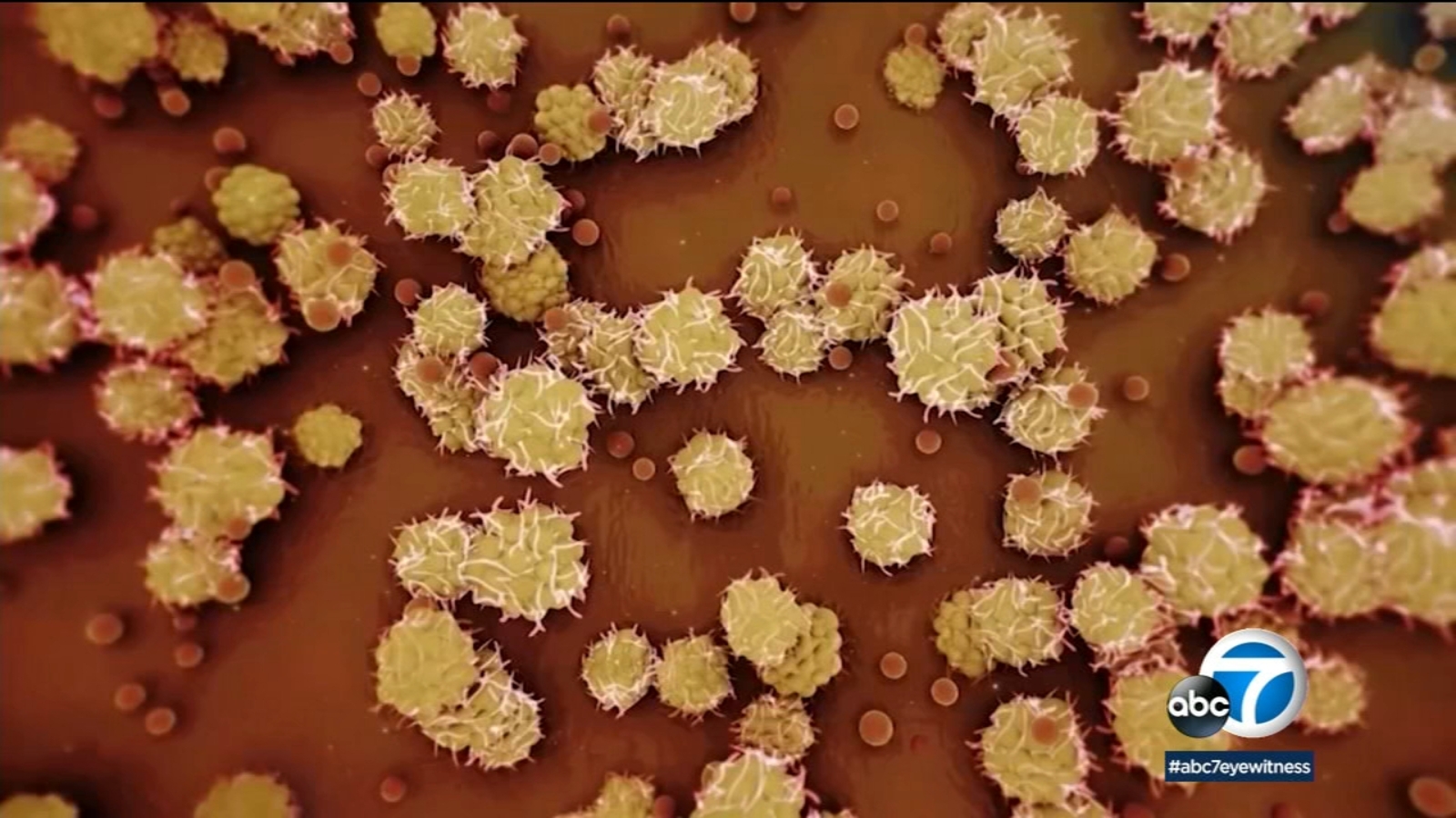 US surpasses 10,000 monkeypox cases; double over last 2 weeks ABC7