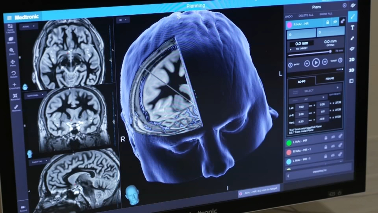 Cognitive gains failed to materialize after 18 months