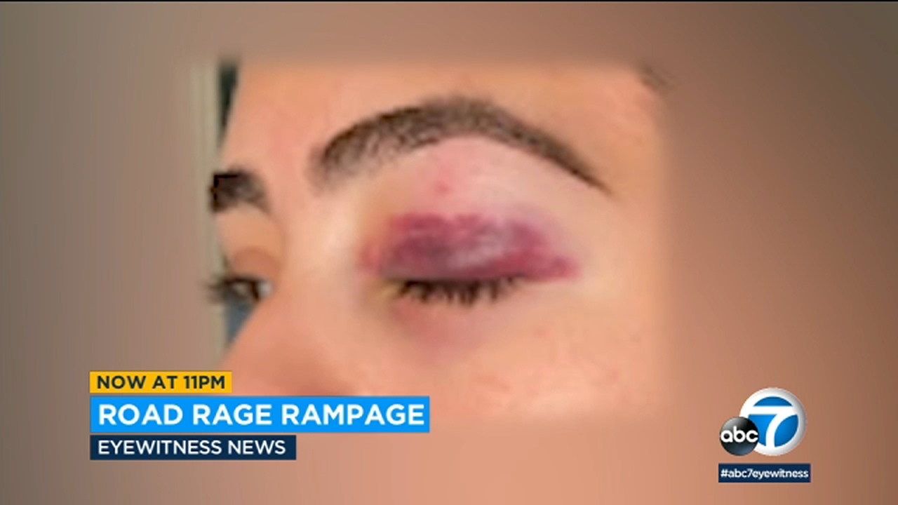 Woman says SoCal road rage suspect left her with black eye