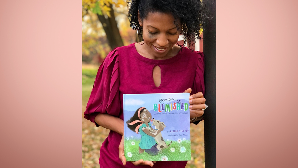 'Beautifully Blemished': New book empowers kids with skin differences