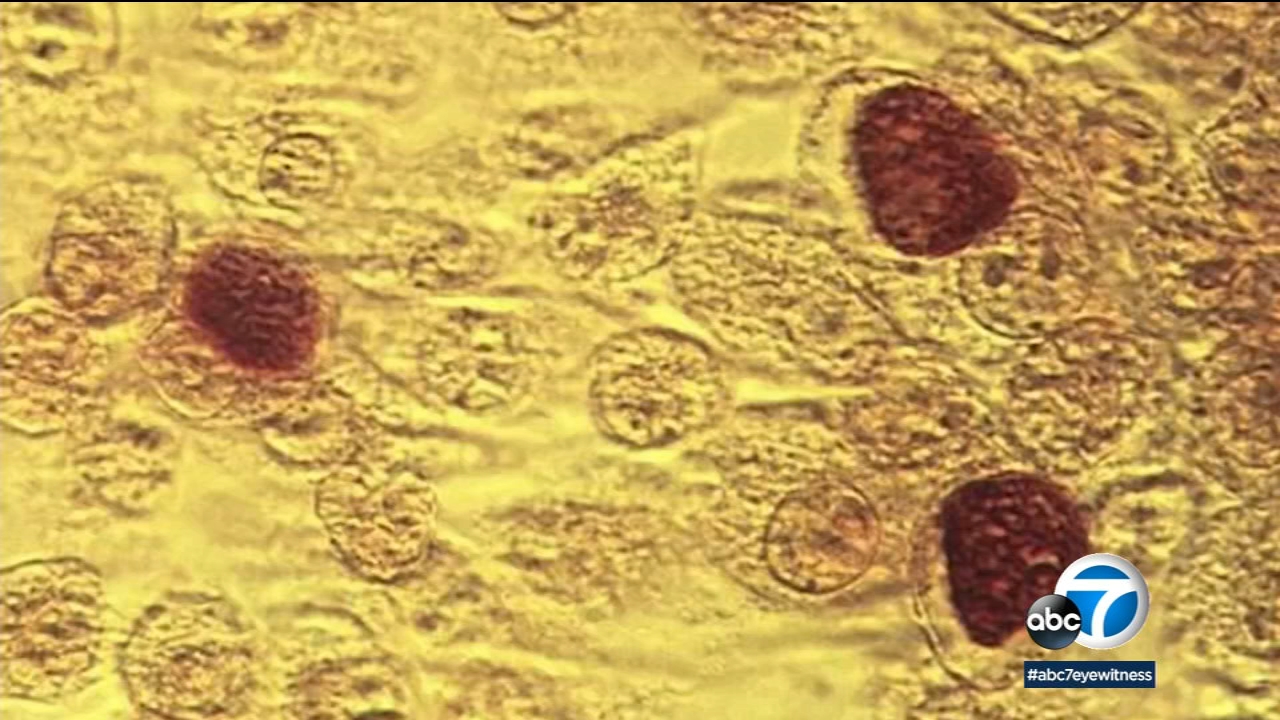 Sexually transmitted infections jumped by 7% in 2021, CDC says