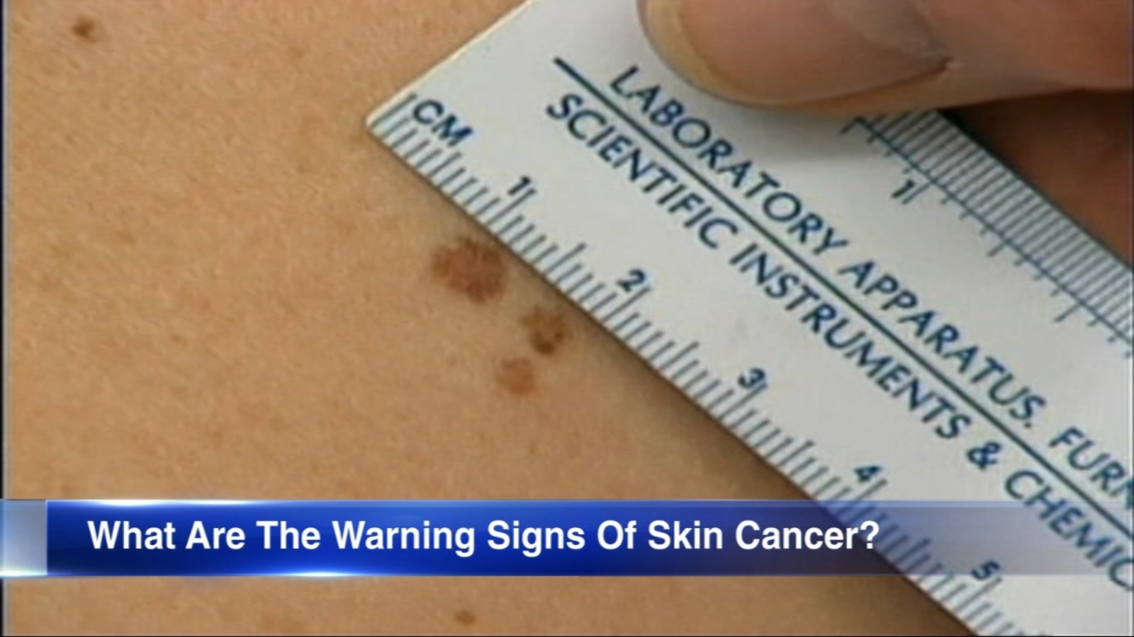 What to know about melanoma as summer approaches ABC7 Chicago