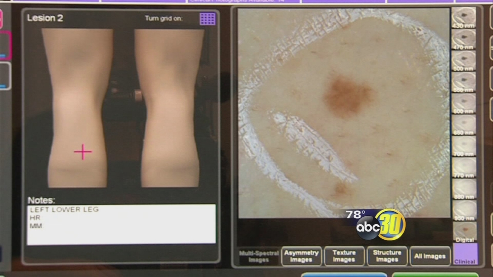 Melanoma and Pregnancy A Deadly Combo ABC30 Fresno