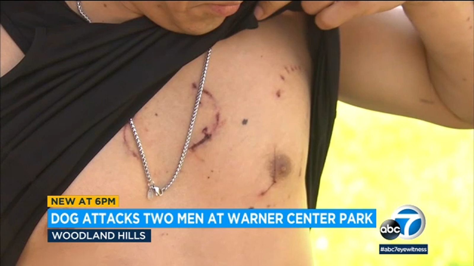 Off-leash dog mauls 2 men at Woodland Hills park, owner flees scene - Vimarsana News