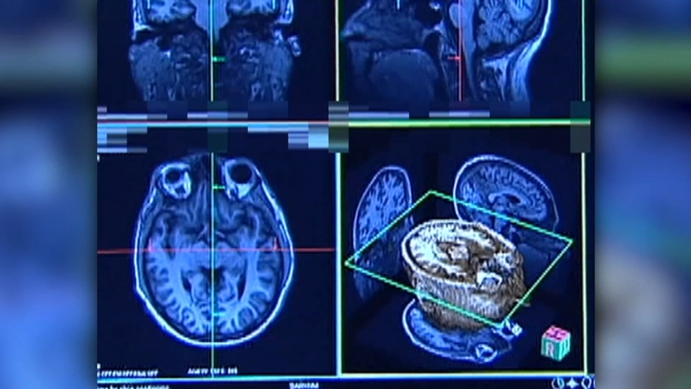 Study shows young athletes may be at risk of traumatic brain disorders
