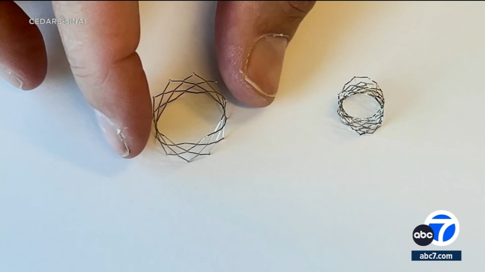 Brain stents for stroke patients offer new hope this holiday season - Vimarsana News