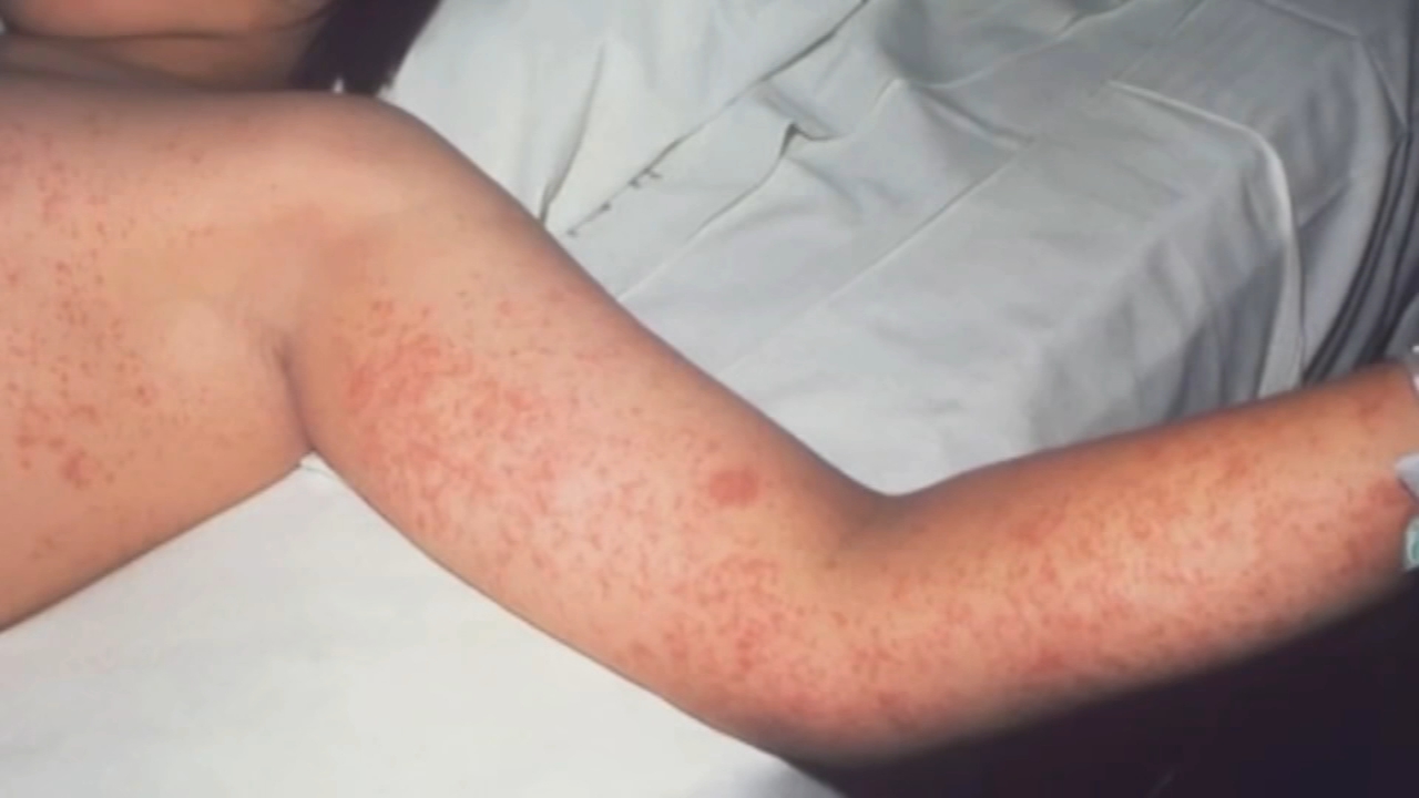 Officials warn of 2 possible measles exposure sites in Montgomery County, Pa.