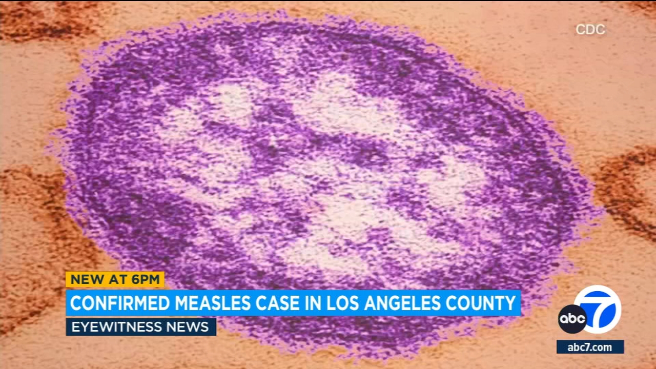 Health officials warn of possible measles exposure at LAX