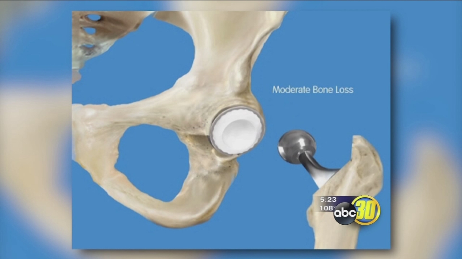 Hip Resurfacing ABC30 Fresno