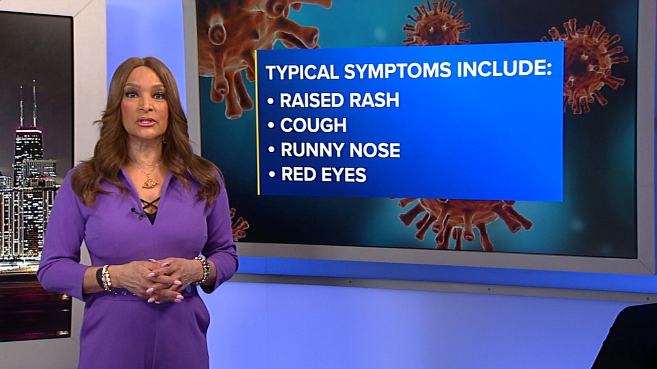 NW Ind. measles patient sought care in Chicago while contagious: CDPH