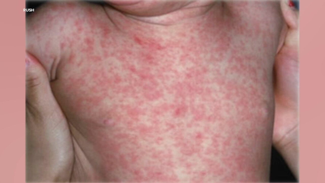 Chicago measles case confirmed, first since 2019