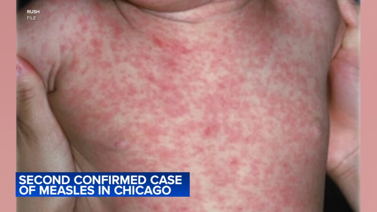 Child staying at Chicago migrant shelter diagnosed with measles