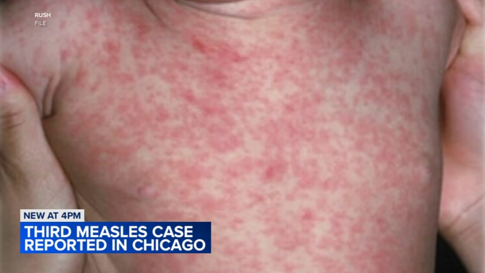 Measles outbreak Chicago 2nd child at Pilsen migrant shelter diagnosed in citys 3rd case CDC to send response team CDPH says WLSTV Measles outbreak Chicago 2nd child at Pilsen migrant shelter diagnosed in citys 3rd case CDC to send response team CDPH says WLSTV