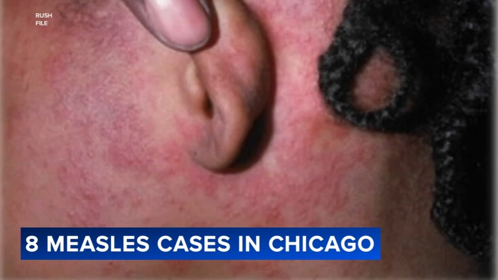 State moves some migrant families to hotels amid measles outbreak