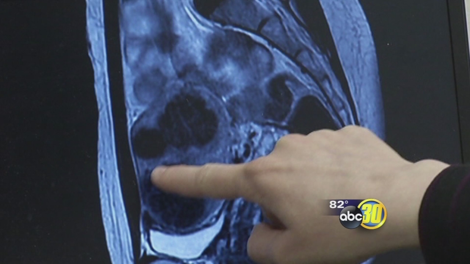 New treatment options shrink fibroids without major surgery ABC30 Fresno