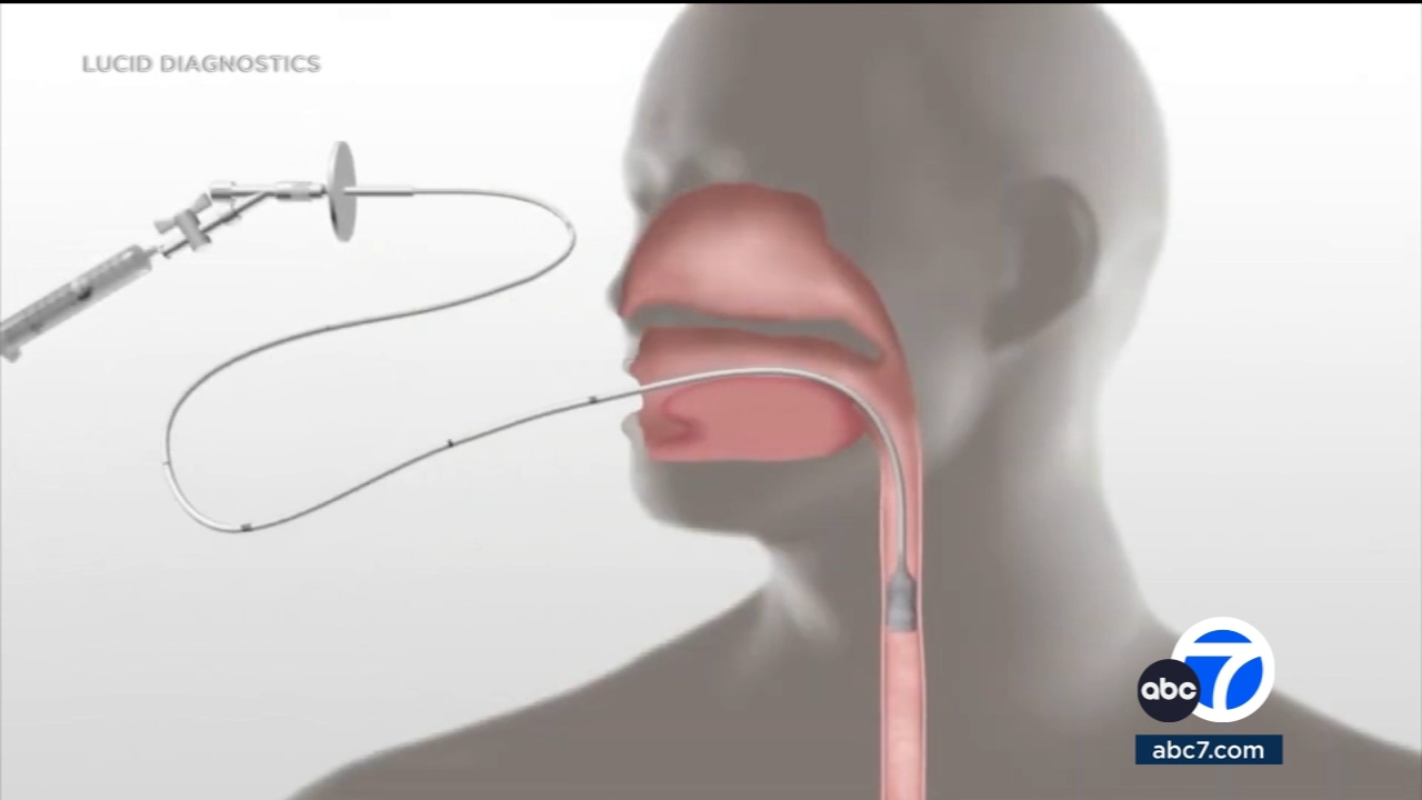 New test can help detect esophageal cancer