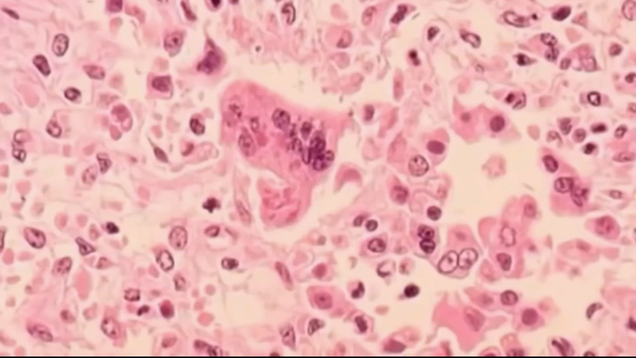 Residents warned of possible measles exposure in Philadelphia & Montco