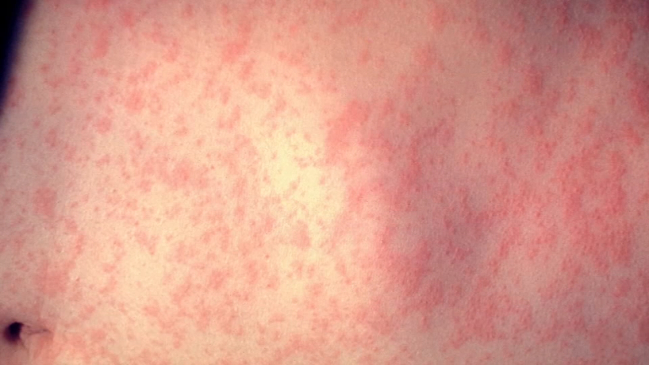 Tulare County officials confirm measles case from traveler
