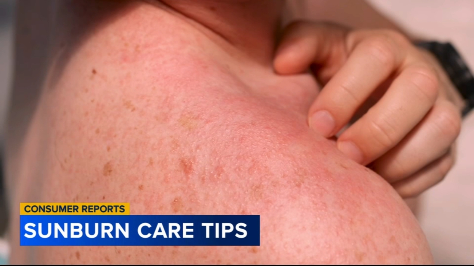 Consumer Reports Best ways to prevent and treat a sunburn 6abc