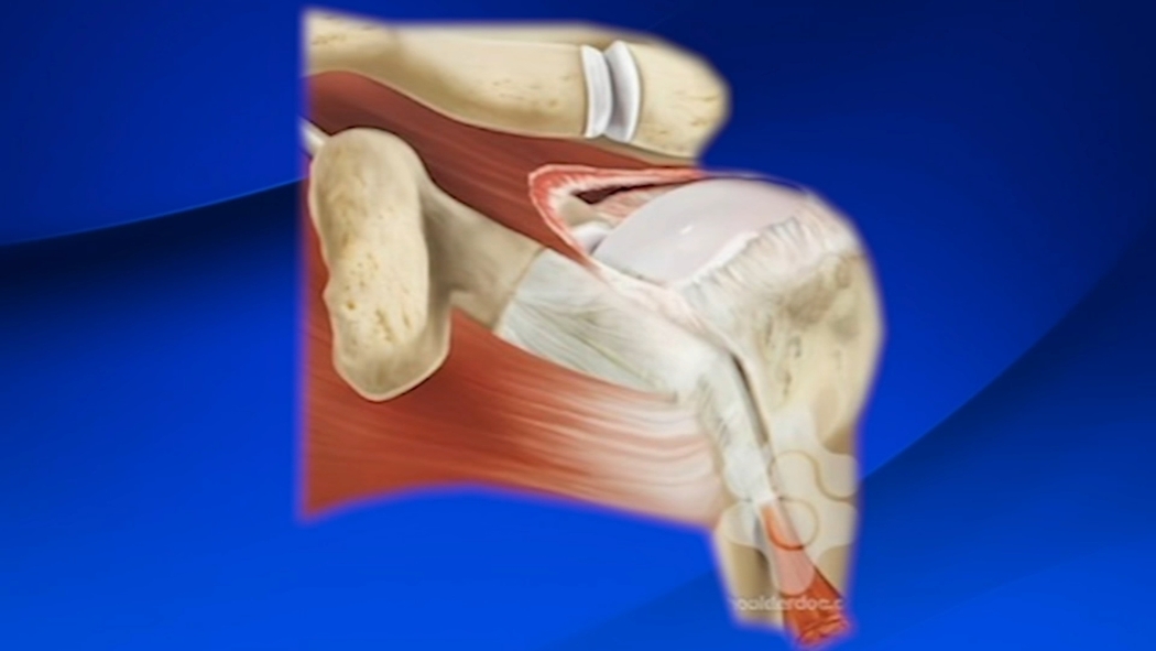 Well Ahead Philly: A skin-based patch changing approaches to rotator cuff  tears - 6abc Philadelphia