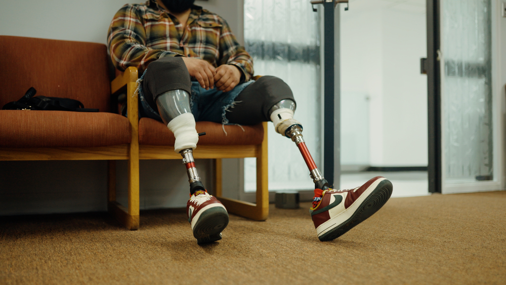 Prosthetics service seeks to help those with limb loss