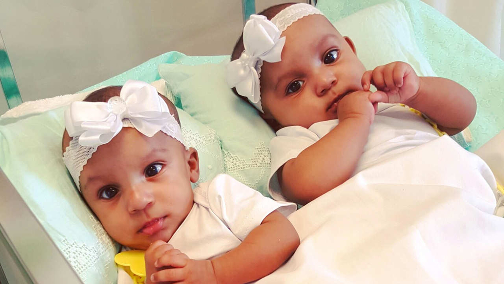 Separated conjoined twins make 1st public appearance