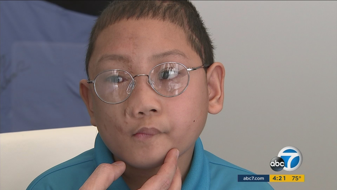 Filipino boy will have much to smile about after face surgery in Beverly Hills
