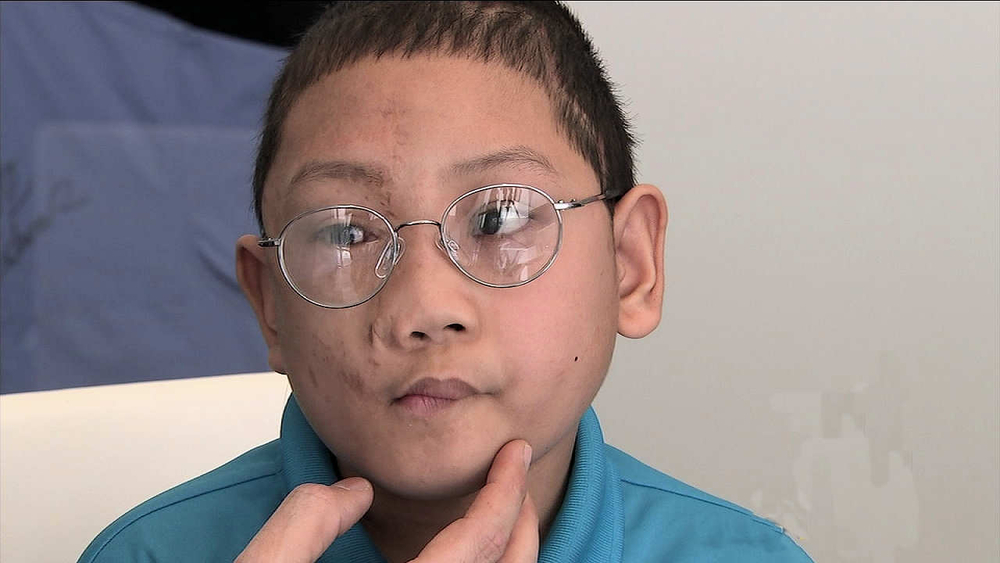 Filipino boy will have much to smile about after face surgery in Beverly Hills