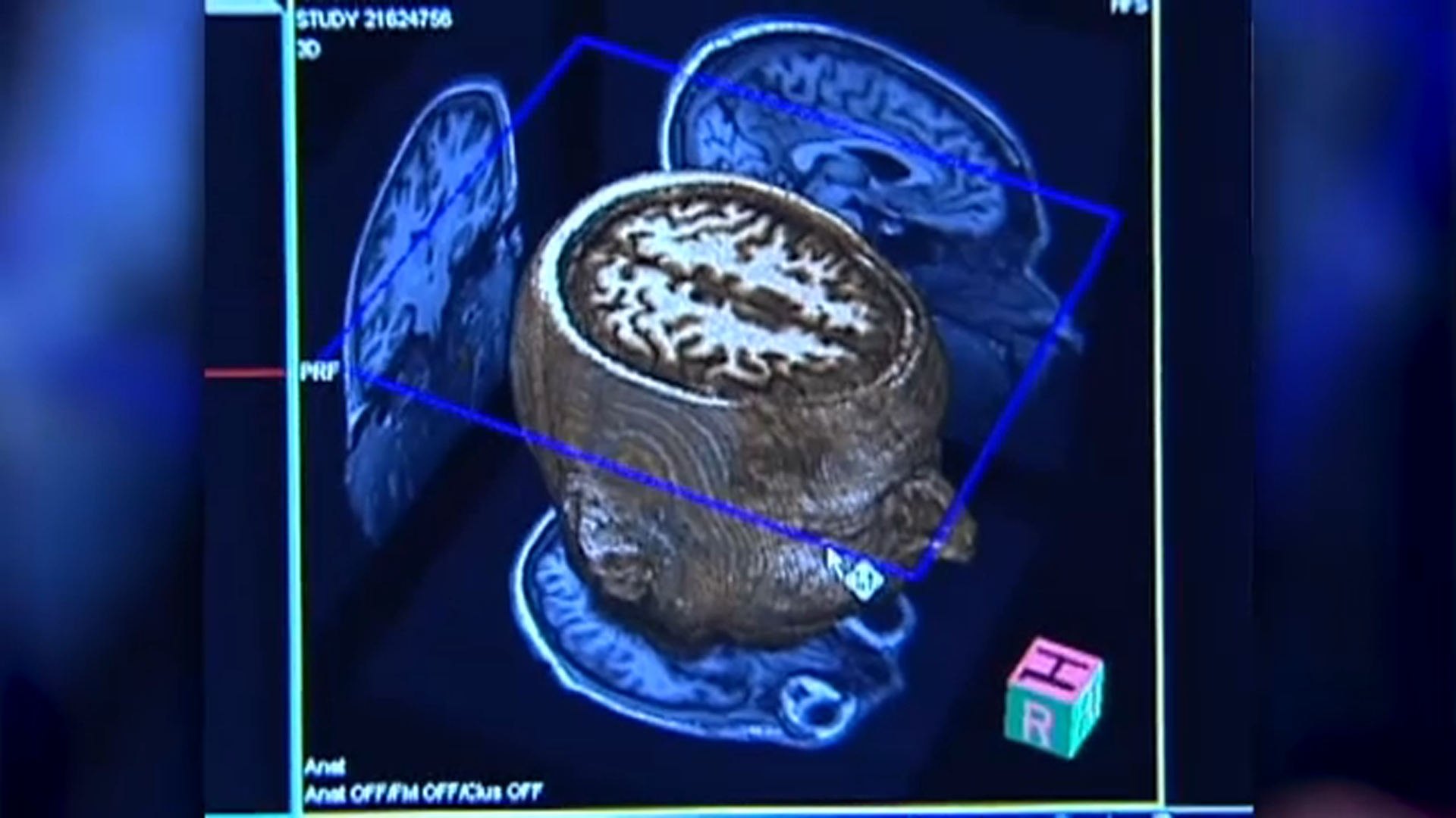 What to know about CTE after NYC gunman's claims